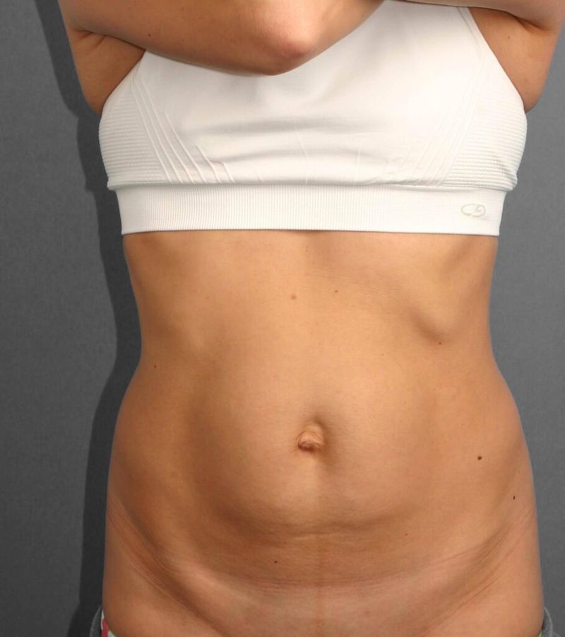 Before — Tummy Tuck