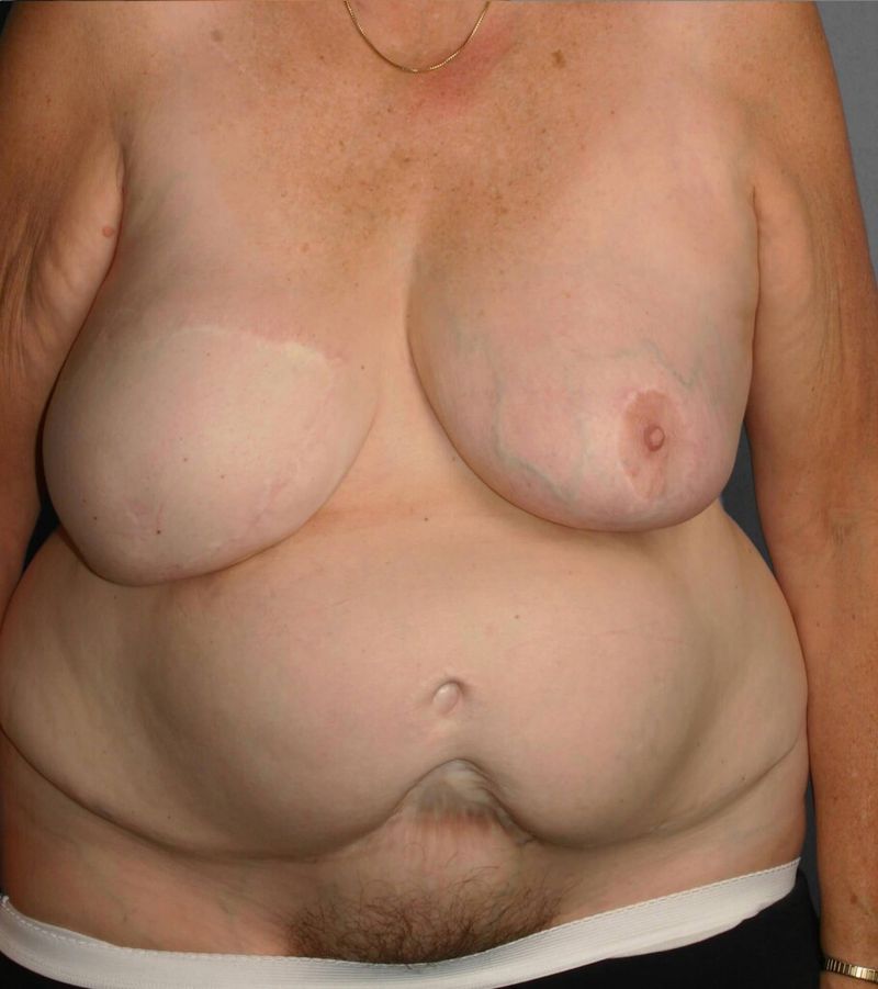Before — Breast Reconstruction Revision