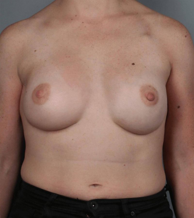 After — Direct-to-Implant Reconstruction
