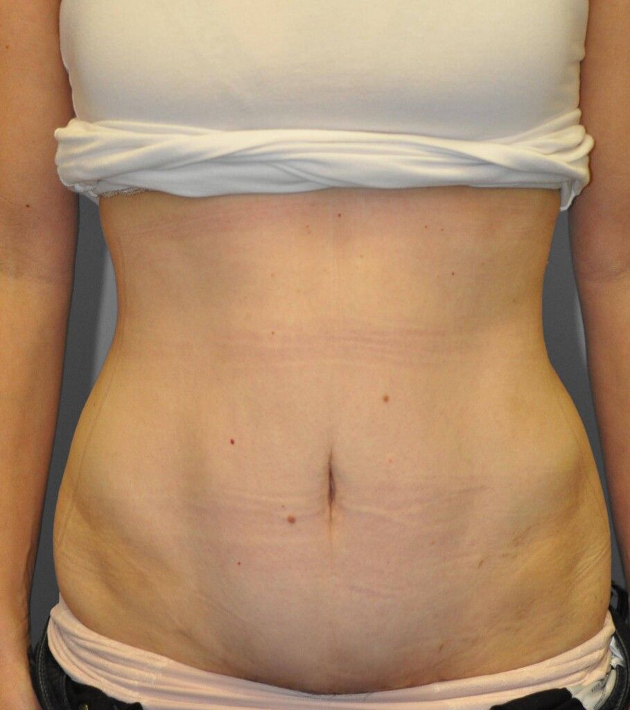 Mommy makeover after photo, mini tummy tuck with diastasis repair, Los Angeles patient, case 1695