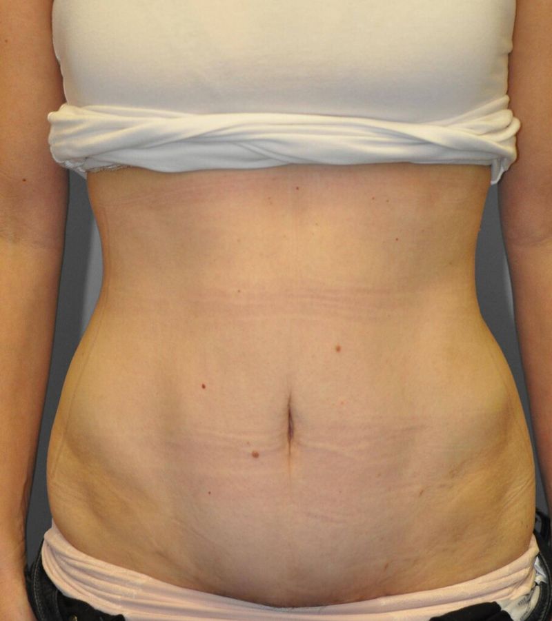 After — Tummy Tuck