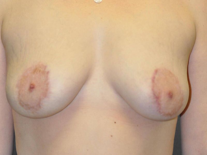 After — Fat Transfer Breast Augmentation