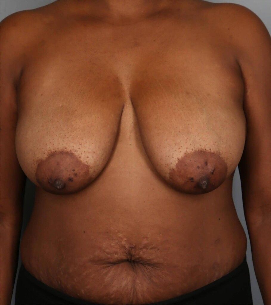 Before — SWIM Flap Reconstruction