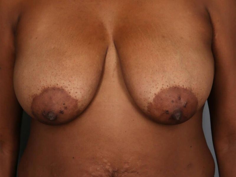Before — SWIM Flap Reconstruction