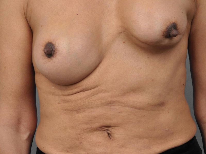 Before — Breast Implant Replacement