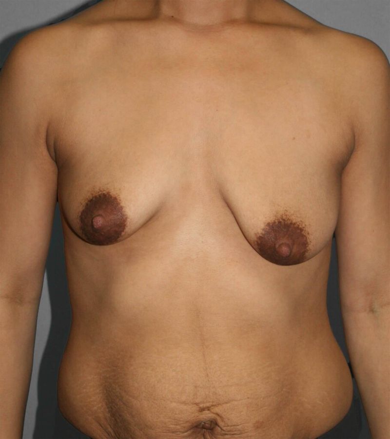 Before — Breast Augmentation