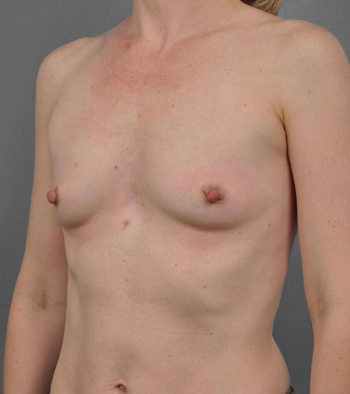 Case 1567 — Oblique before