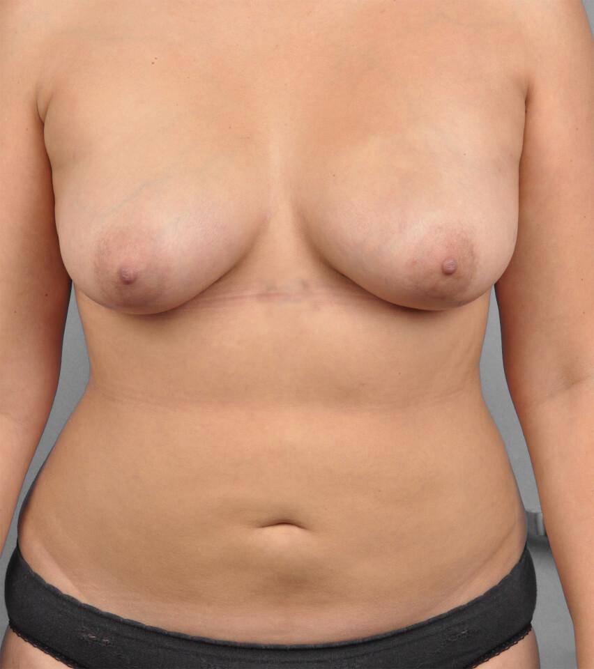 After — Fat Transfer Breast Augmentation