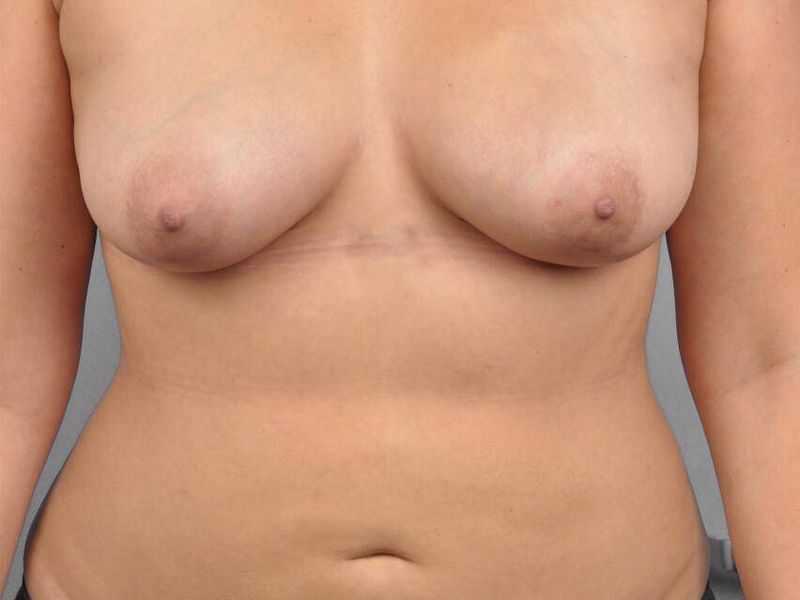 After — Fat Transfer Breast Augmentation