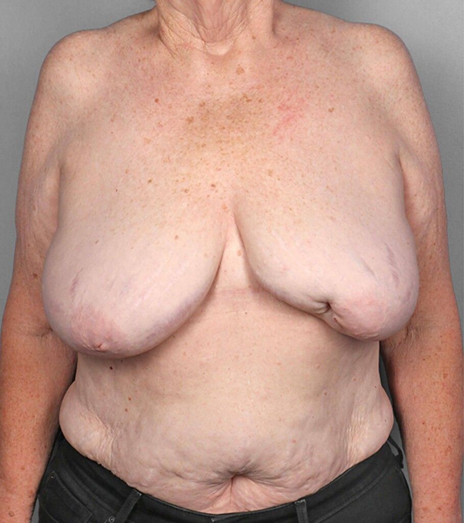 Before — SWIM Flap Reconstruction