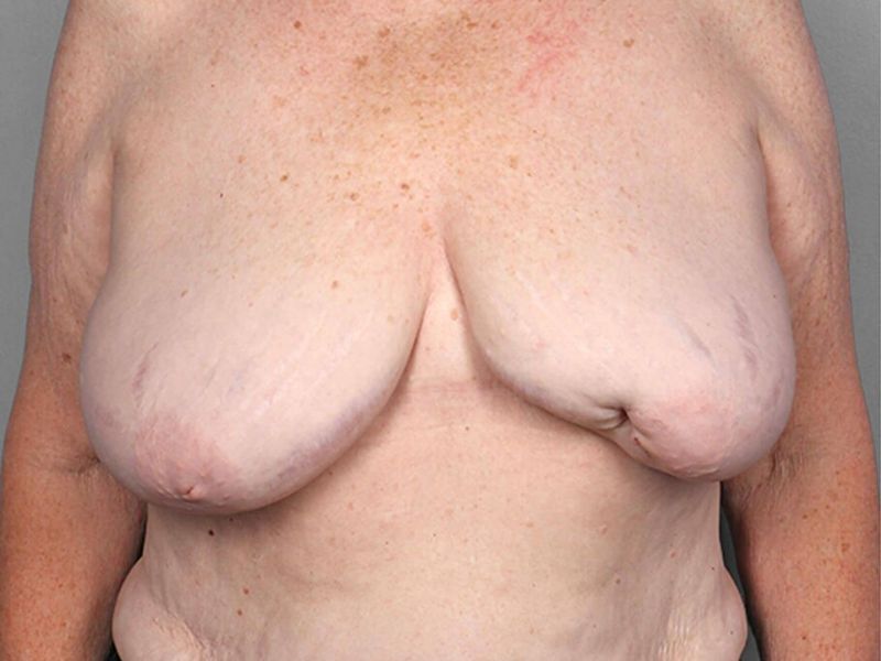 Before — SWIM Flap Reconstruction