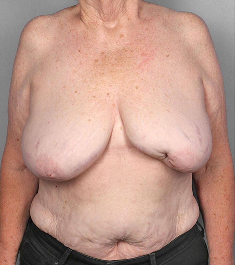 Before — SWIM Flap Reconstruction