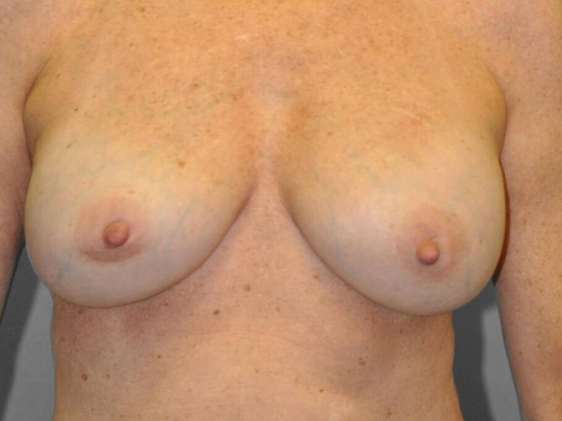 After — Capsular Contracture Treatment