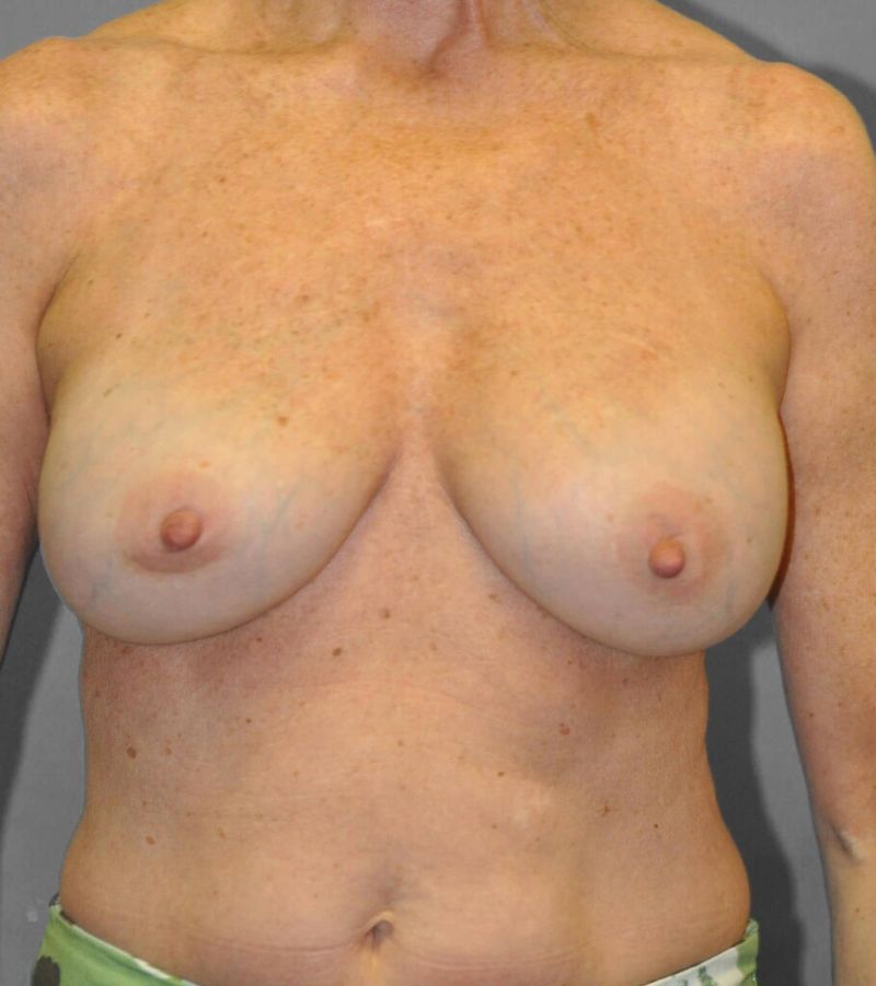 After — Capsular Contracture Treatment
