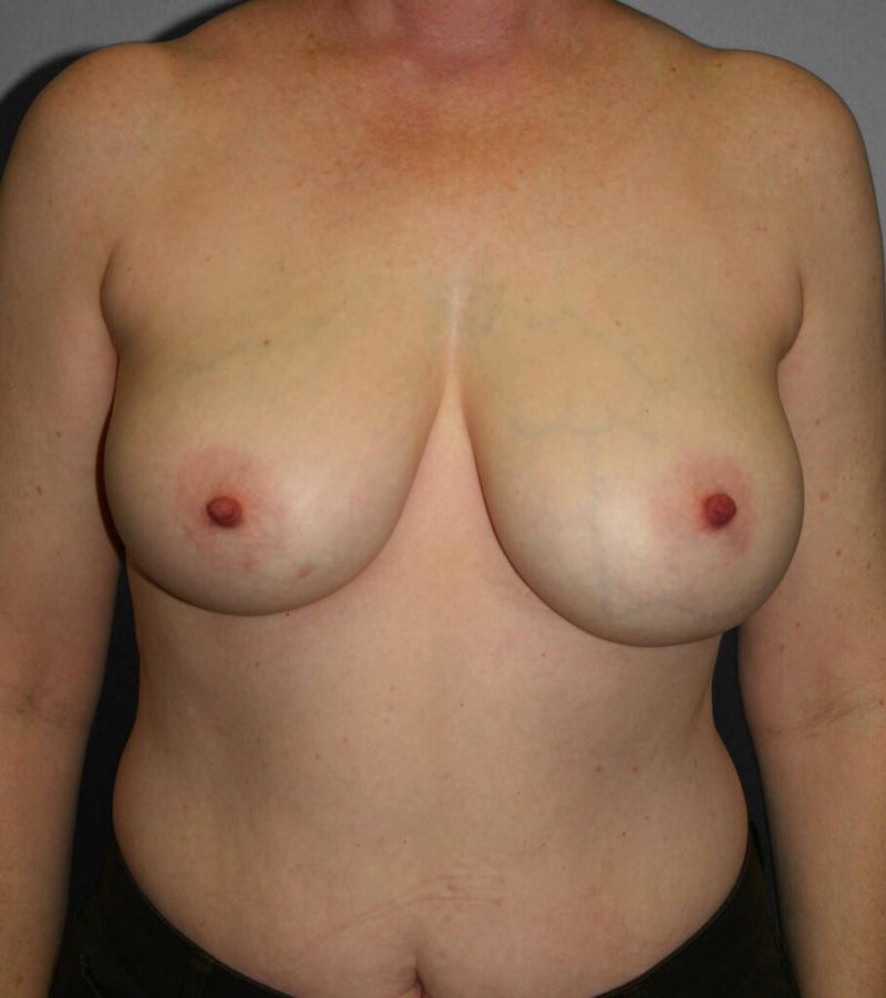 Before — Breast Reduction