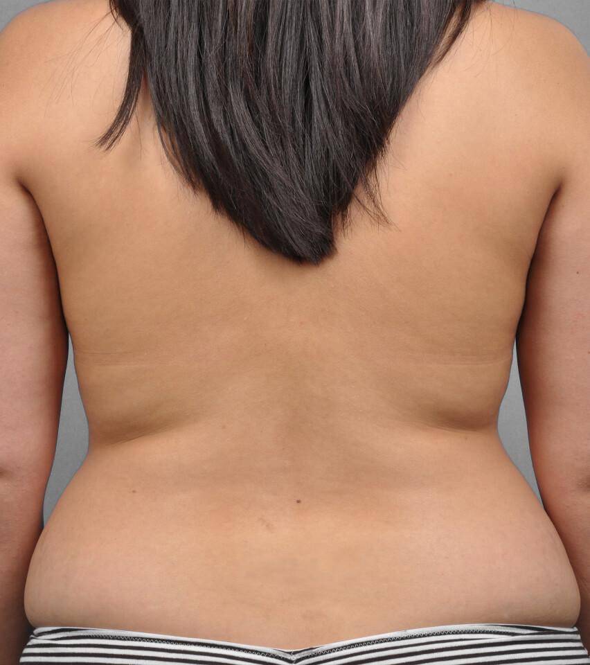 Before — Liposuction