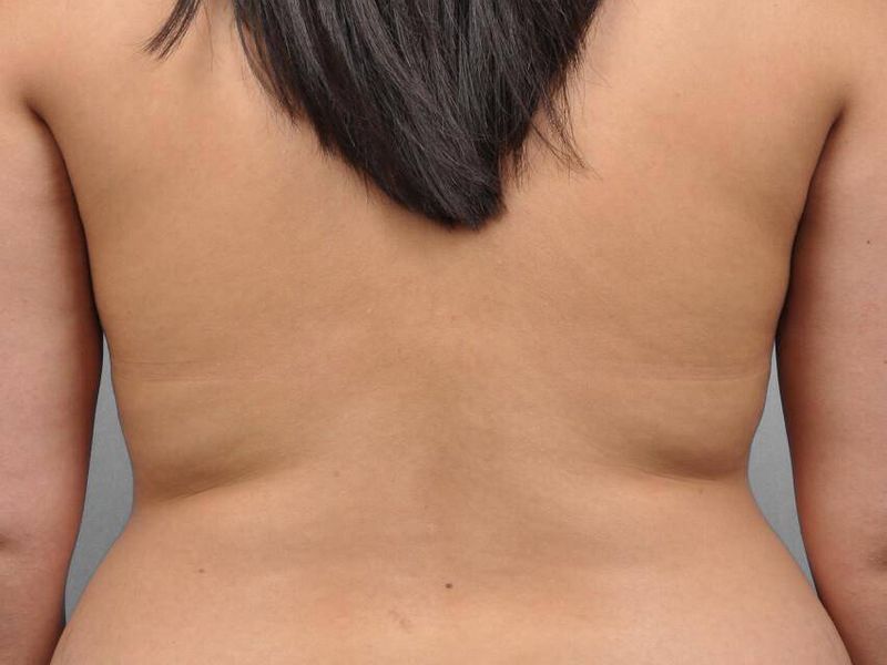 Before — Liposuction