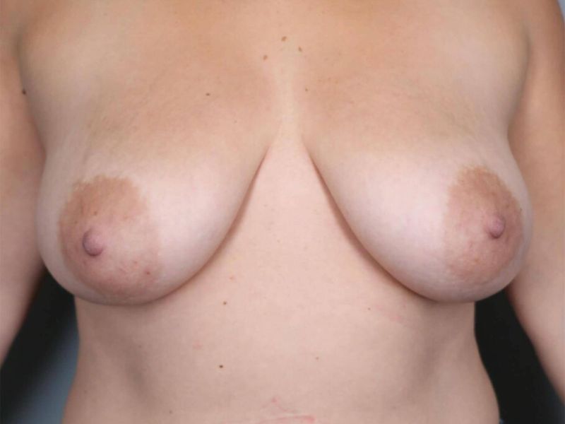 Before — Direct-to-Implant Reconstruction