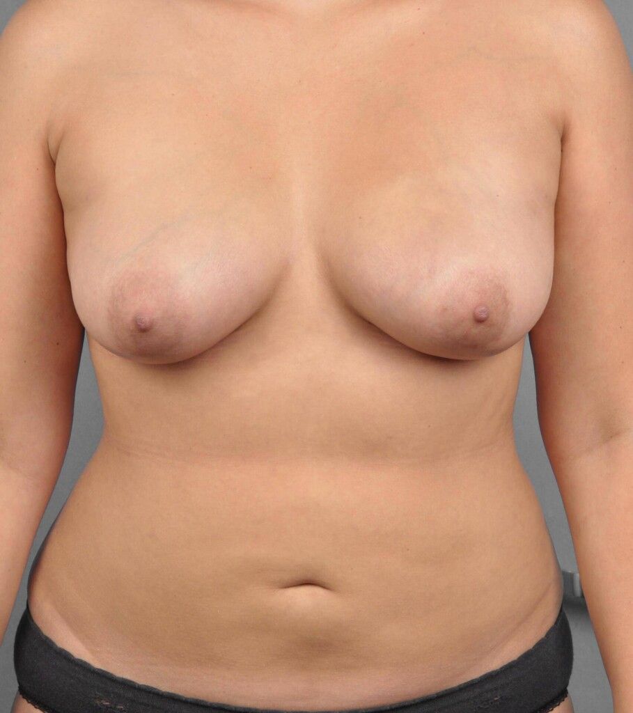 After — Liposuction
