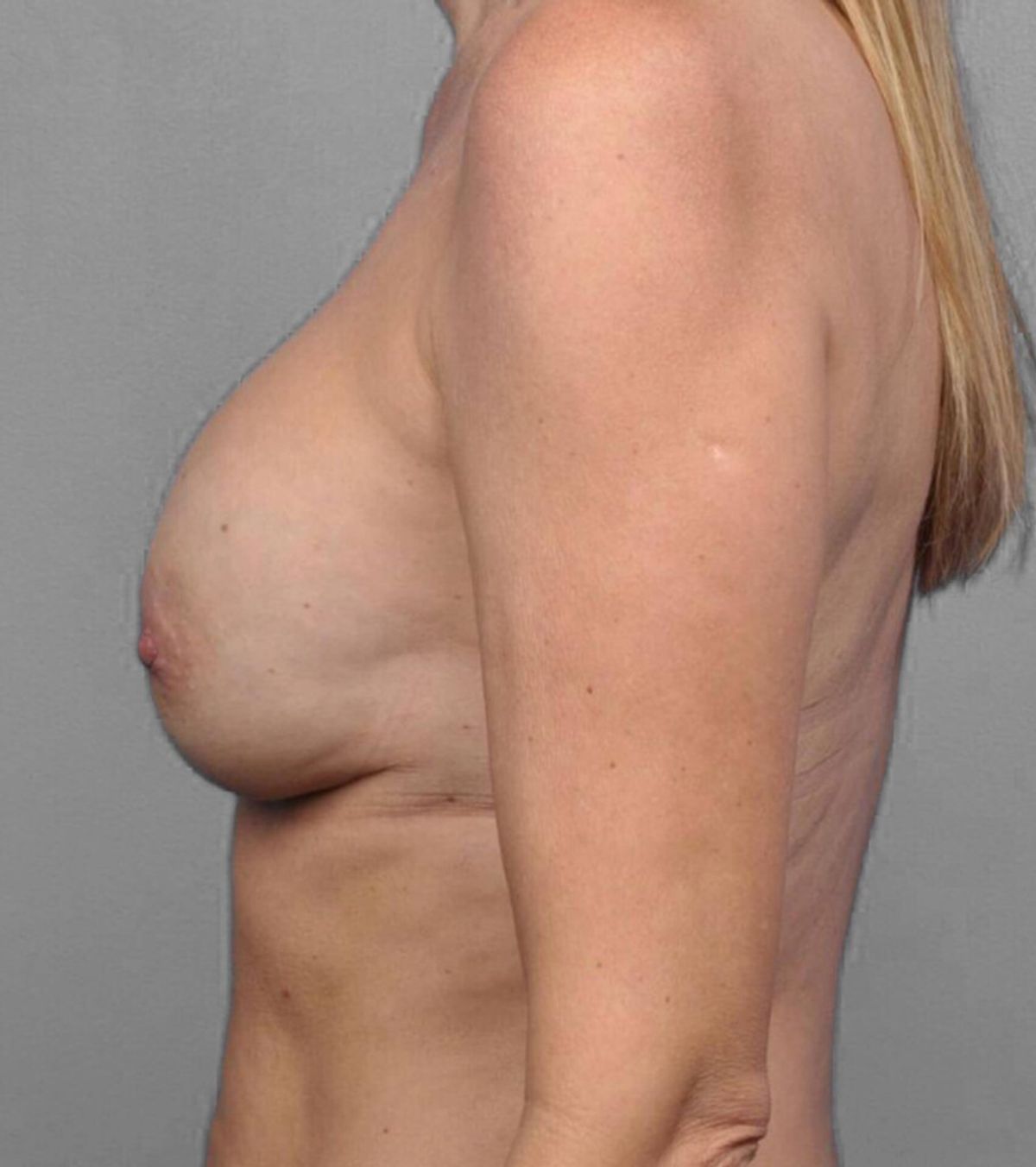 Case 1569 — Oblique before