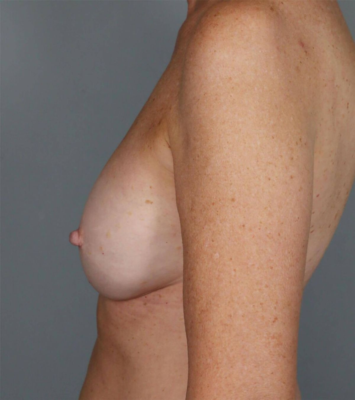 Case 1312 — Oblique after