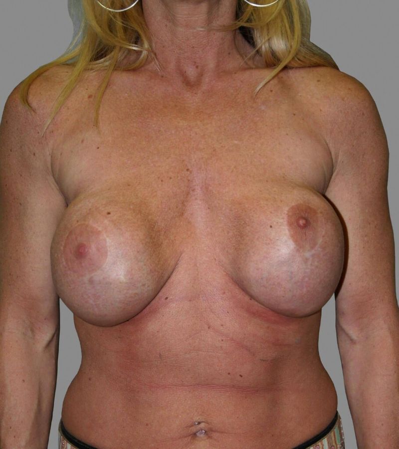 Before — Breast Implant Replacement
