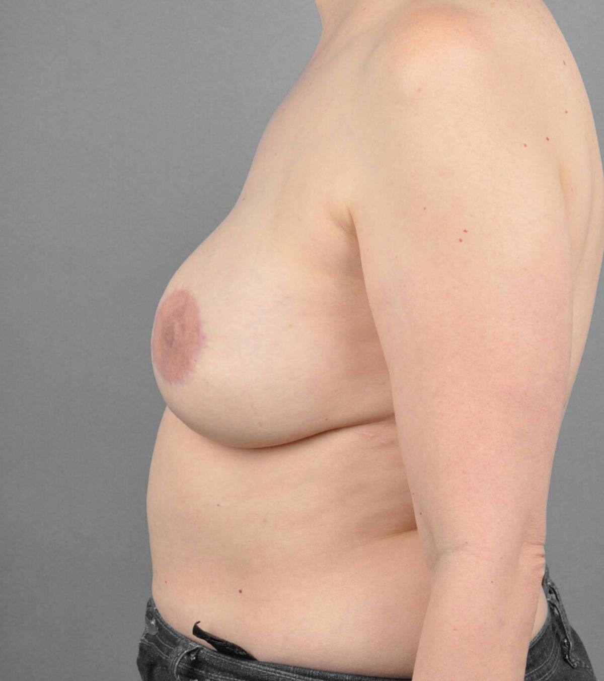 Case 1301 — Oblique after