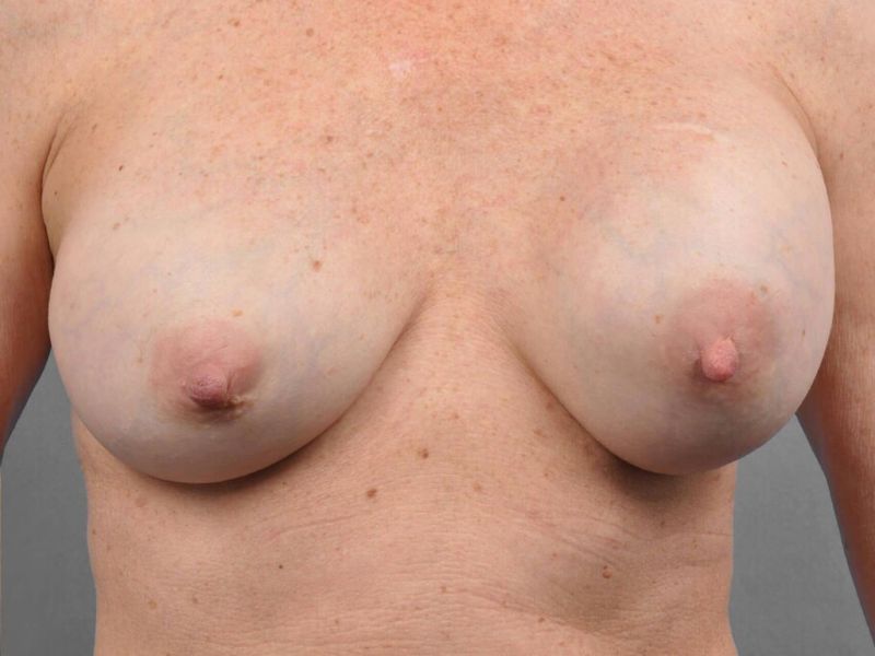 Before — Capsular Contracture Treatment