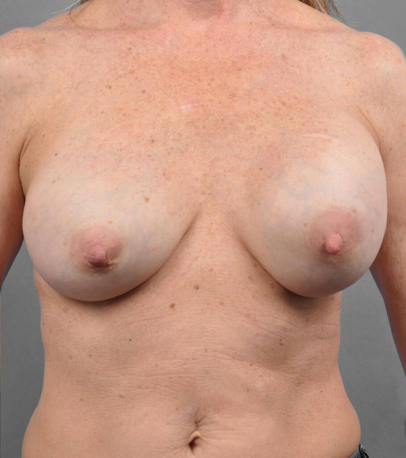 Before — Capsular Contracture Treatment