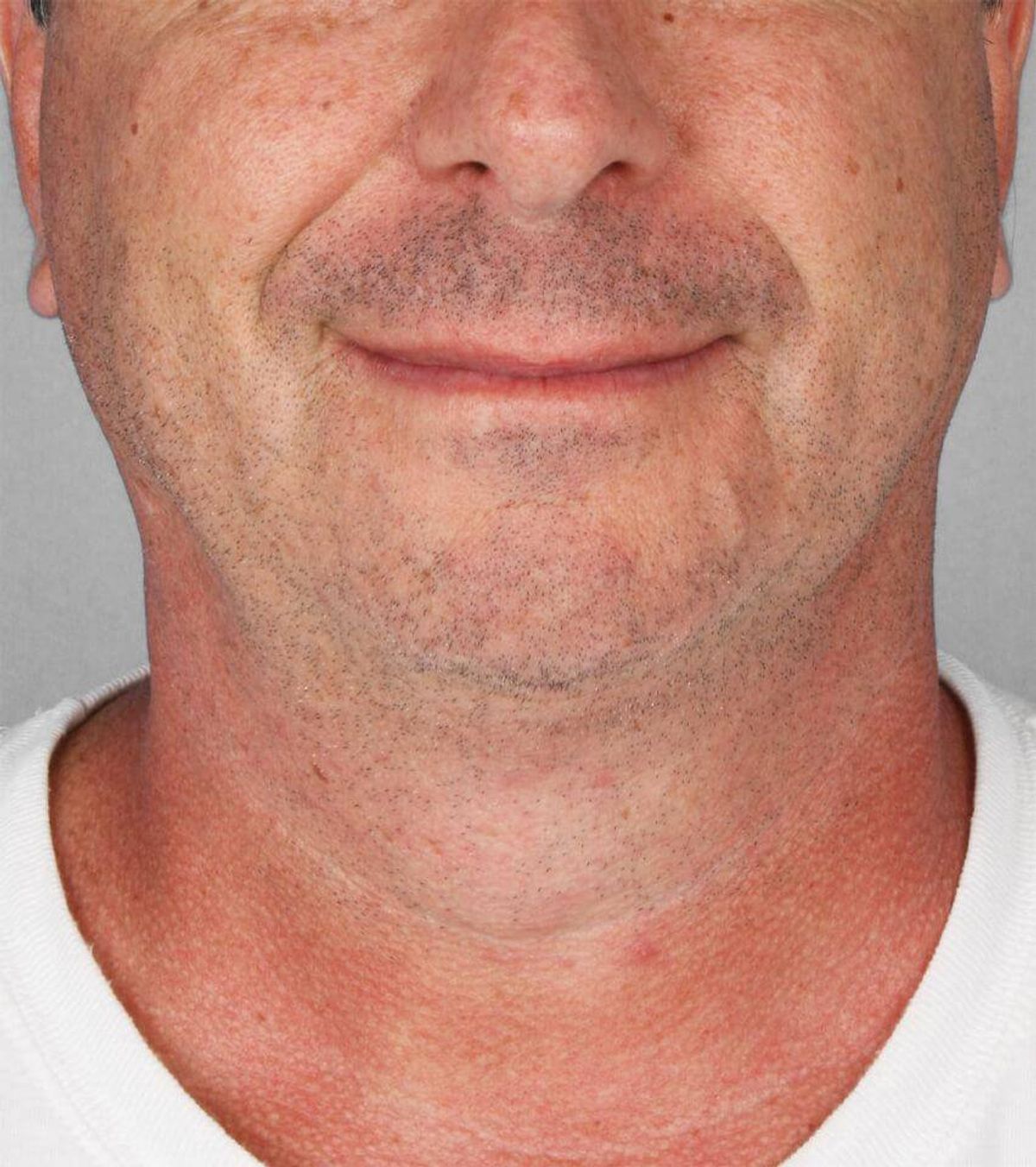 Case 1670 — Front after