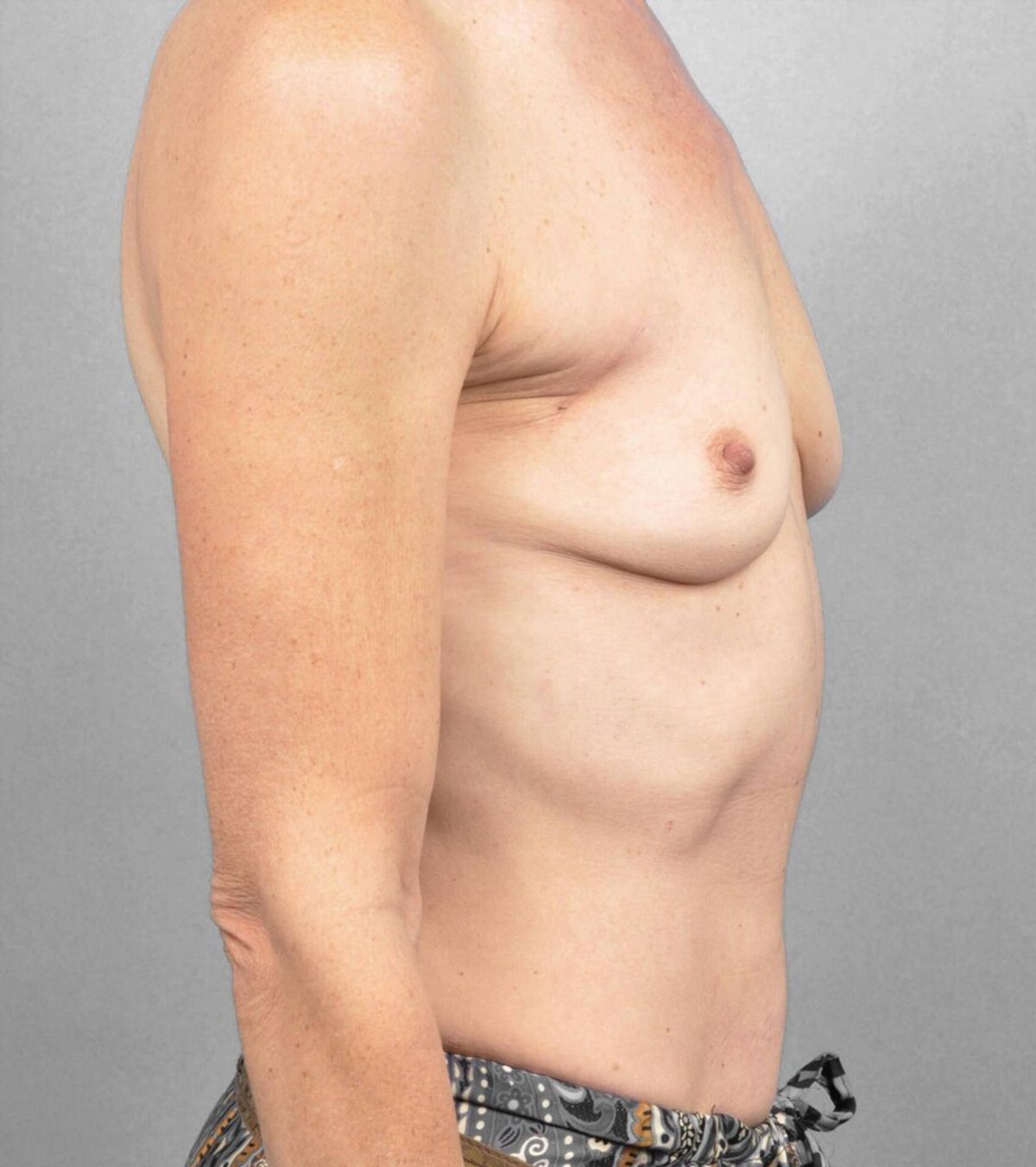 Case 1393 — Oblique before