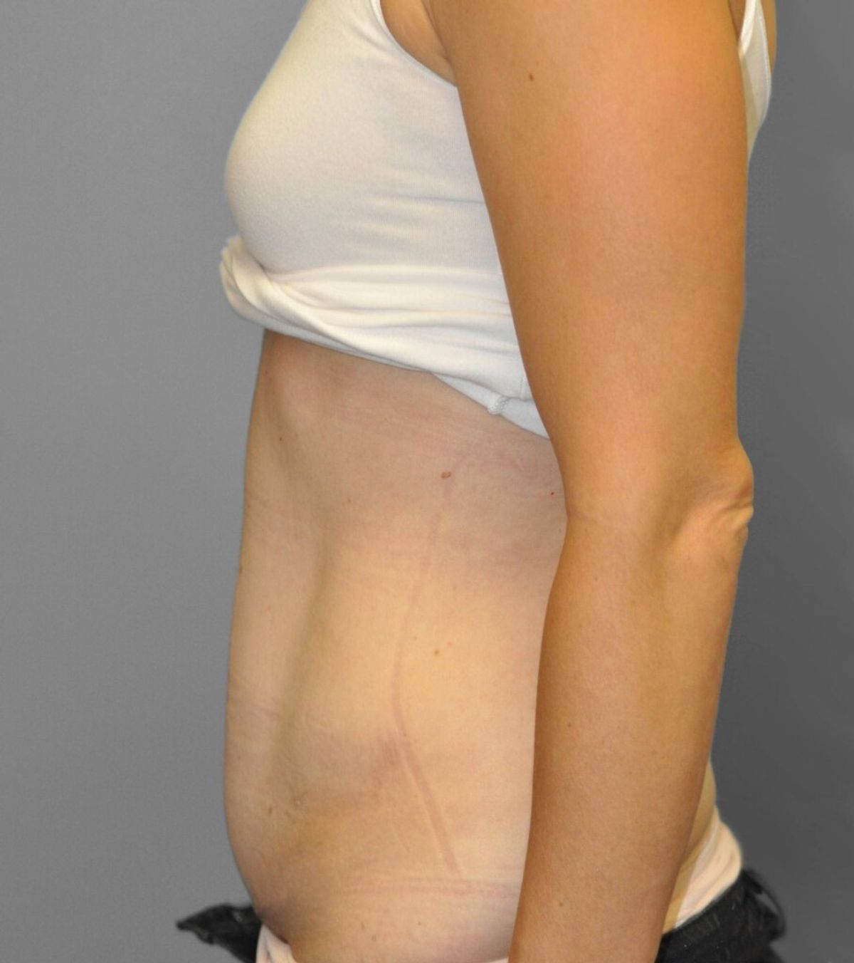 Case 1695 — Oblique after