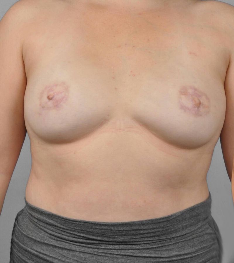 After — Direct-to-Implant Reconstruction