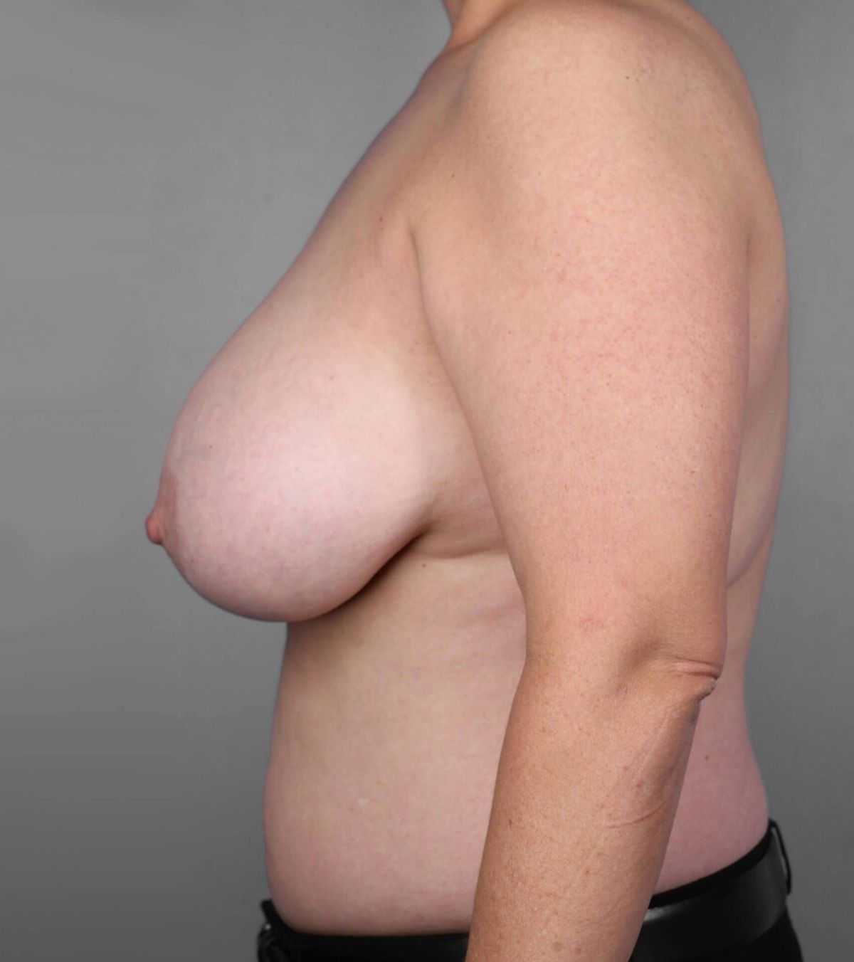 Case 1387 — Oblique before