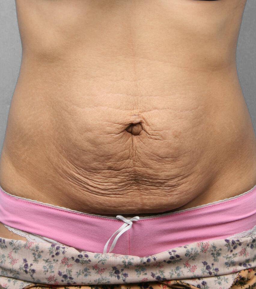 Before — Tummy Tuck