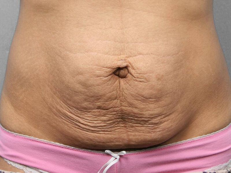 Before — Tummy Tuck