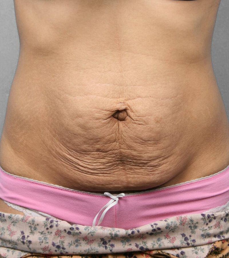 Before — Tummy Tuck