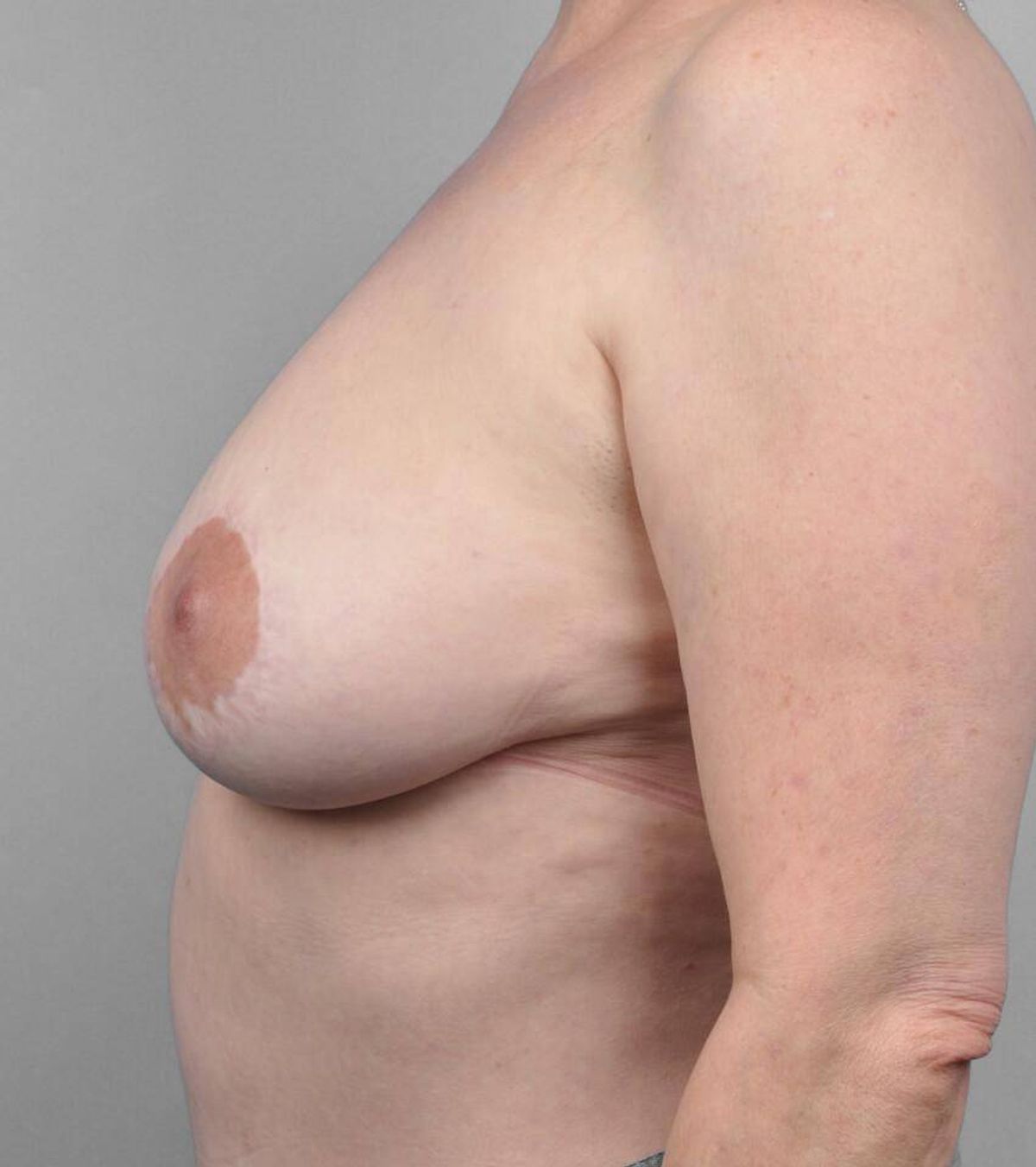 Case 1519 — Oblique after