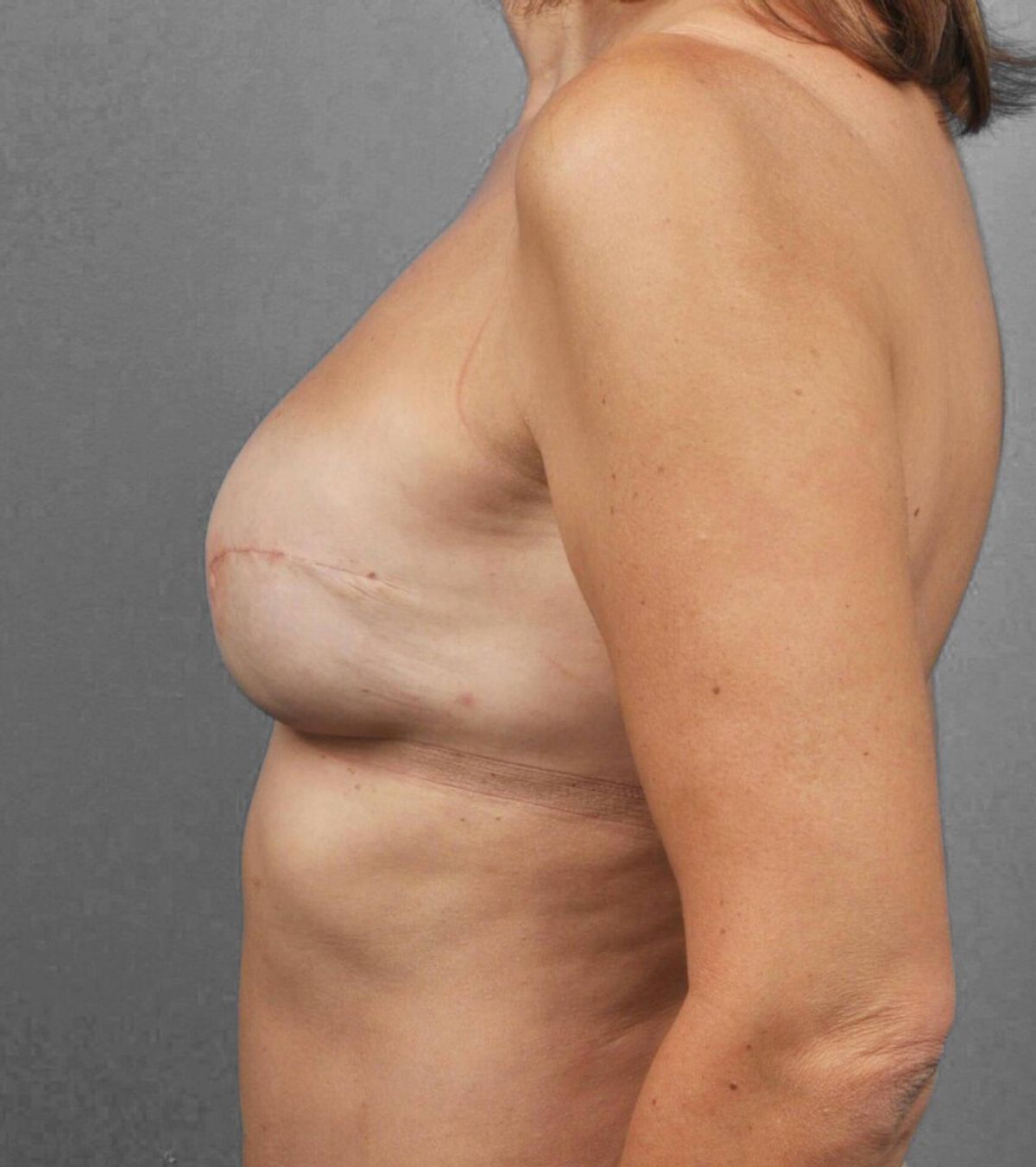 Case 1385 — Oblique after
