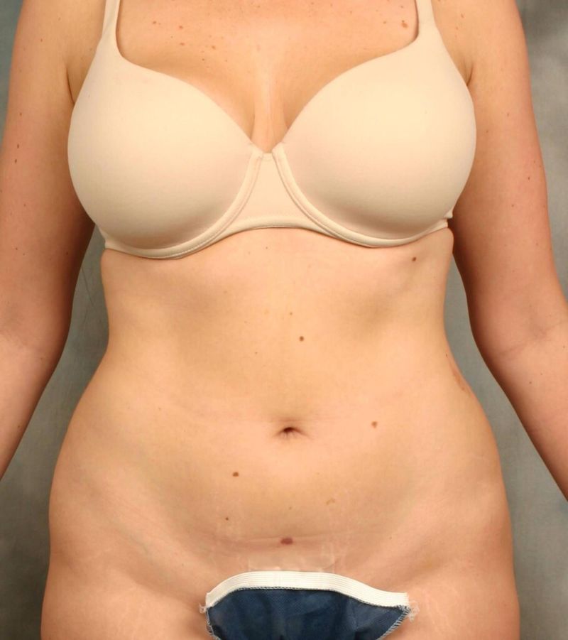 Before — Liposuction