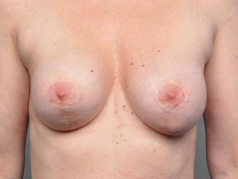 Before — Fat Grafting Breast Reconstruction
