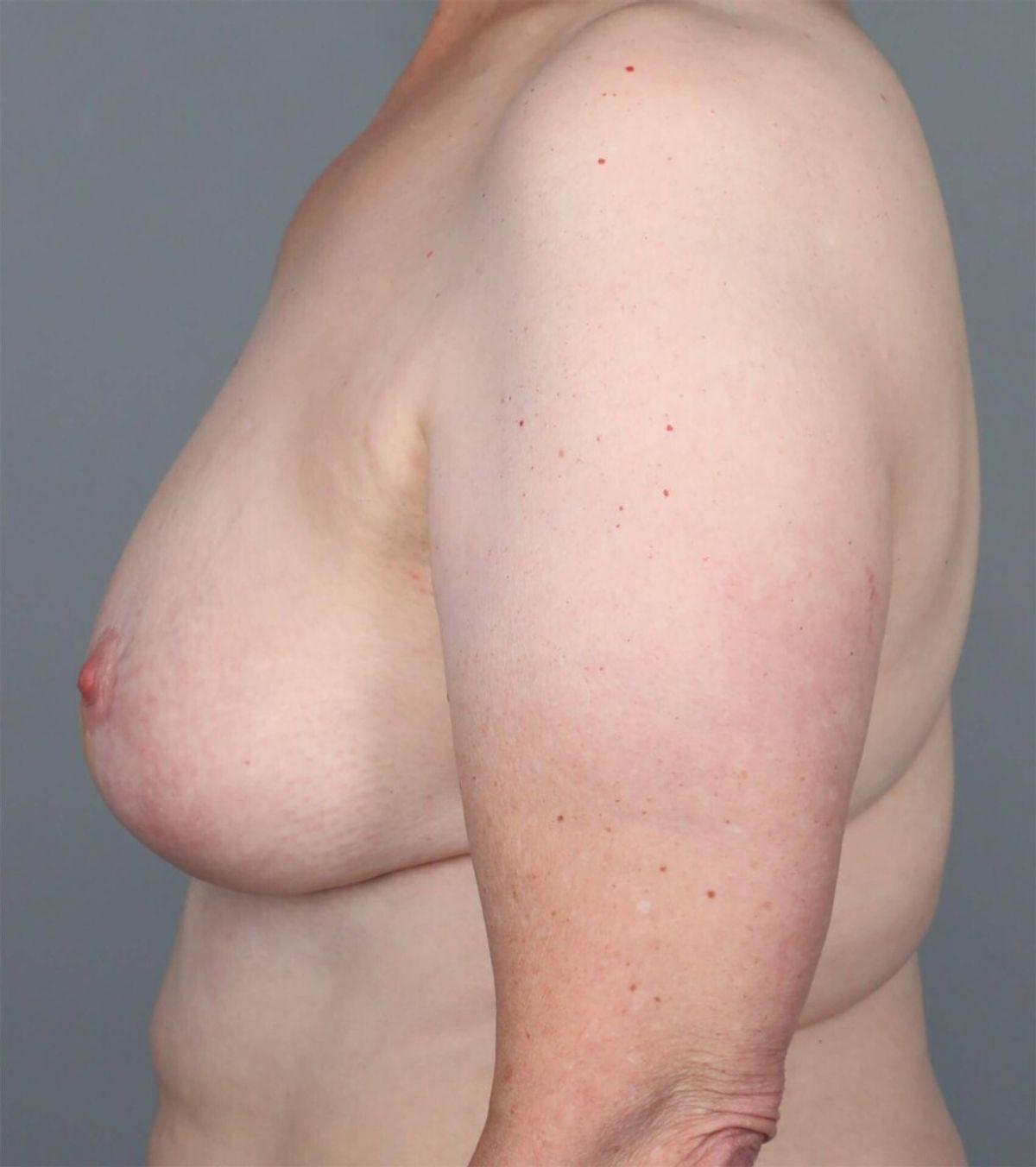 Case 1316 — Oblique before