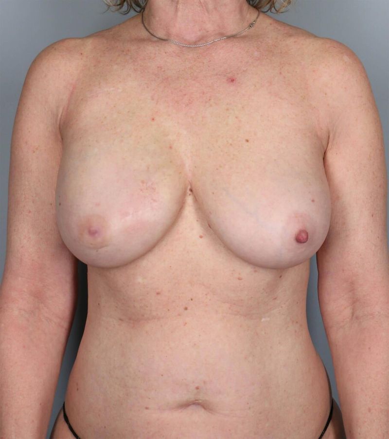 After — Direct-to-Implant Reconstruction