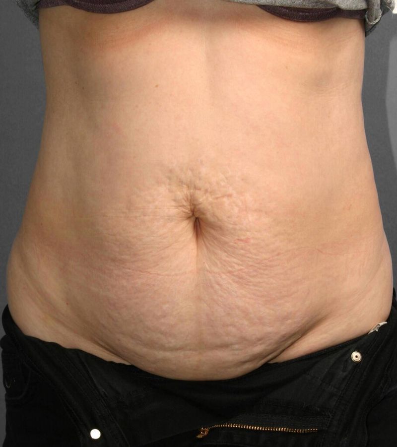 Before — Tummy Tuck