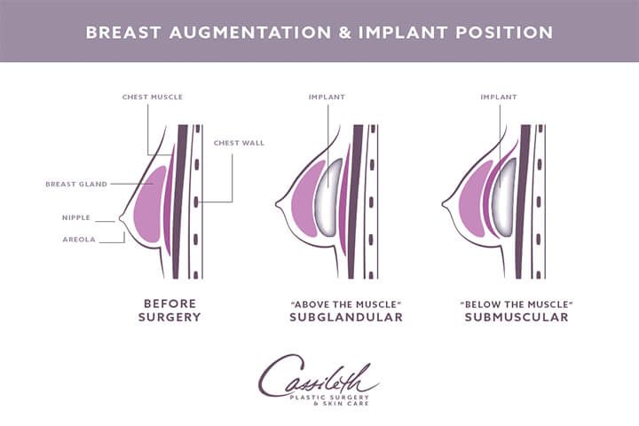 Breast Augmentation: When You Should – Or Shouldn’t – Have Breast Surgery