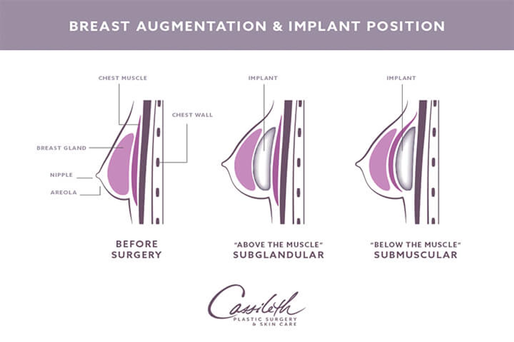Breast Augmentation: When You Should – Or Shouldn’t – Have Breast Surgery