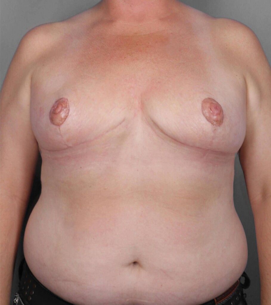 After — SWIM Flap Reconstruction