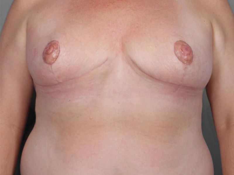 After — SWIM Flap Reconstruction