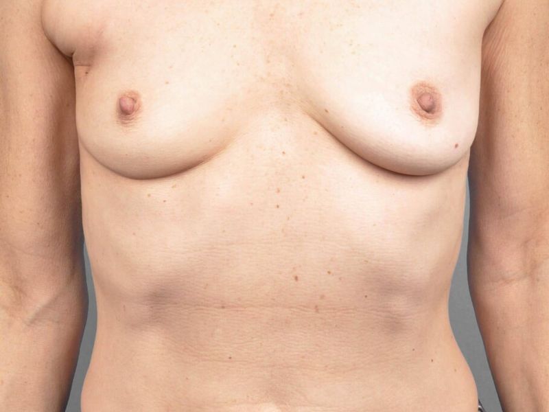 Before — Breast Reconstruction Revision
