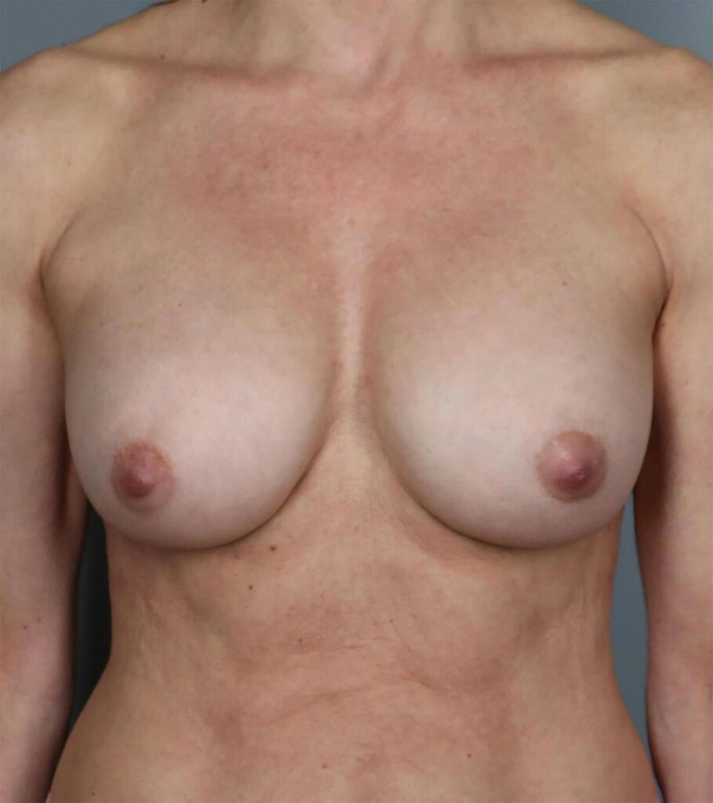 After — Breast Implant Replacement